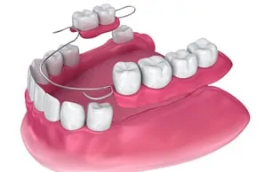 partial dental bridge